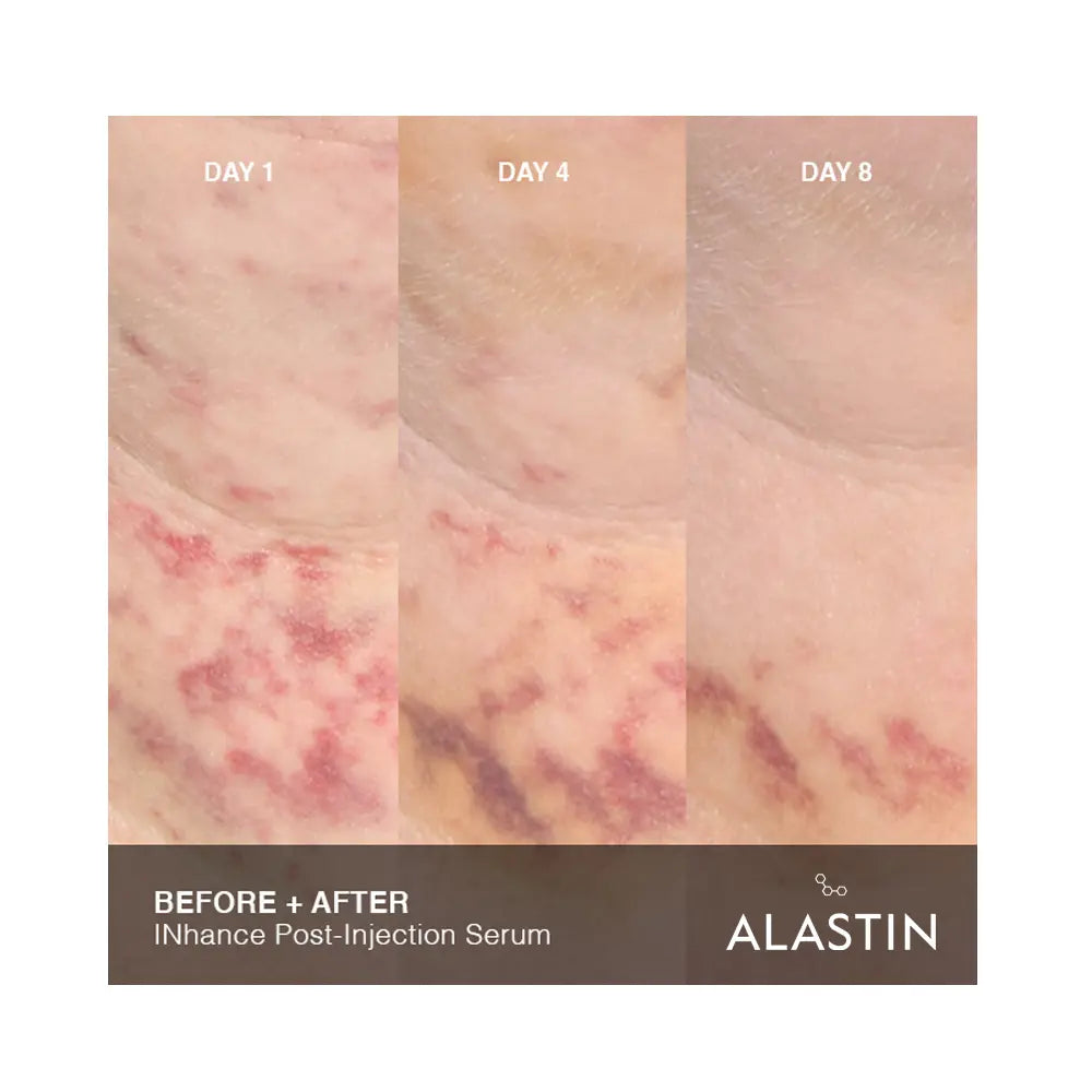 Alastin INhance Post-Injection Serum with TriHex Technology