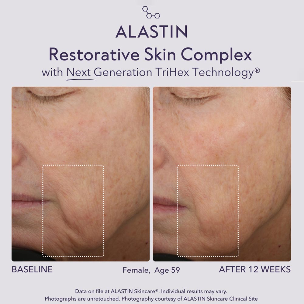 Before and after comparison of ALASTIN Restorative Skin Complex on a woman's face with visible wrinkles.