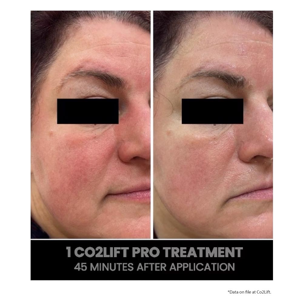 CO2Lift Pro Carboxy Gel Treatment 1 Count - Your Skincare Source