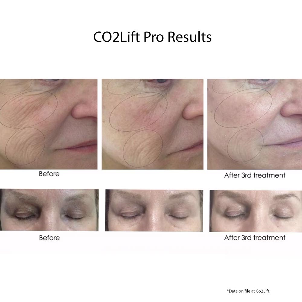 CO2Lift Pro Carboxy Gel Treatment 1 Count - Your Skincare Source