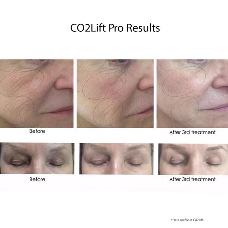 CO2Lift Pro Carboxy Gel Treatment 1 Count - Your Skincare Source