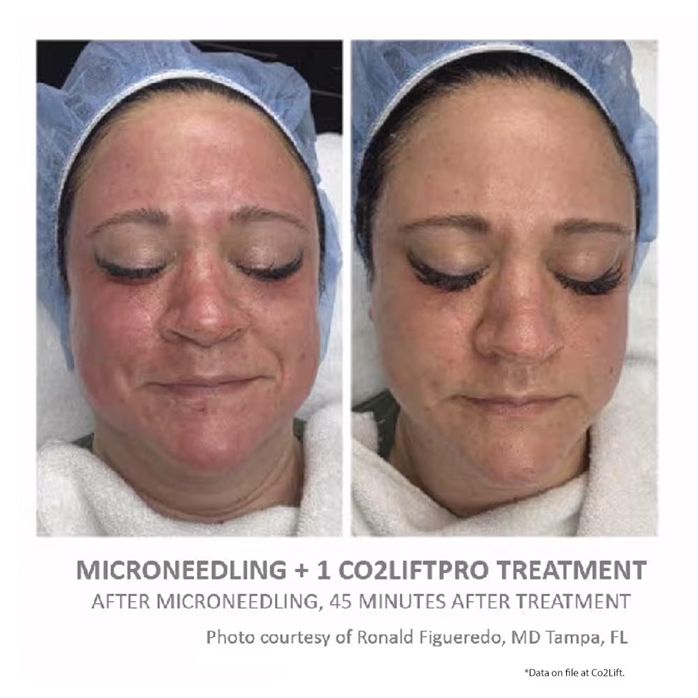 CO2Lift Pro Carboxy Gel Treatment 1 Count - Your Skincare Source