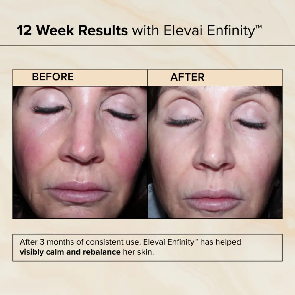 Before and after 12 weeks of Elevai Enfinity Exosome Daily Serum showing visibly calmer, more even facial skin