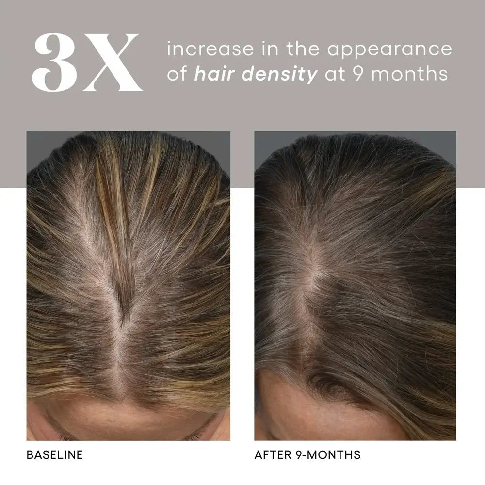 Before and after comparison of hair density with a 3x increase at 9 months.