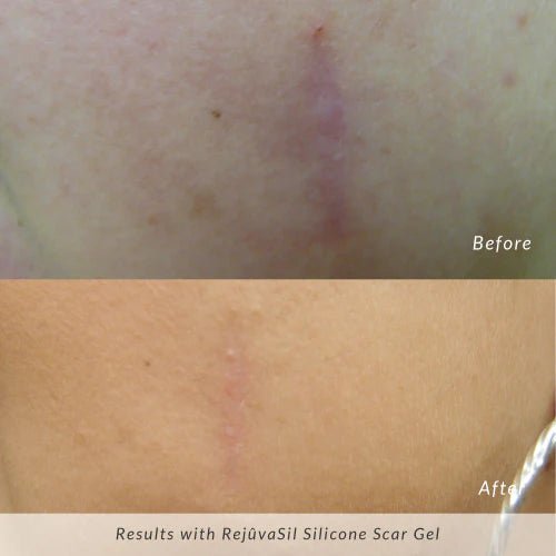 Rejûvaskin RejûvaSil Silicone Scar Gel - Your Skincare Source