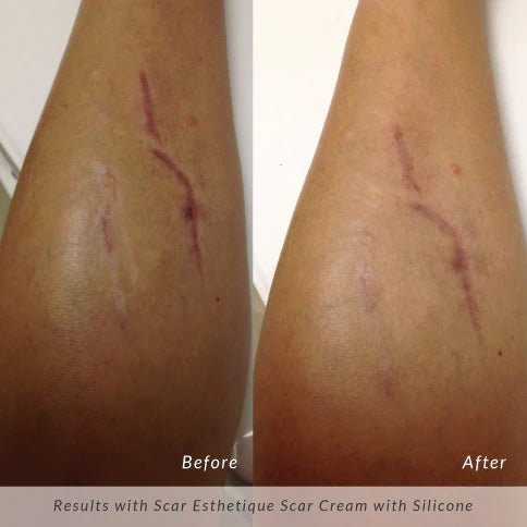 Rejûvaskin Scar Esthetique Scar Cream - Your Skincare Source