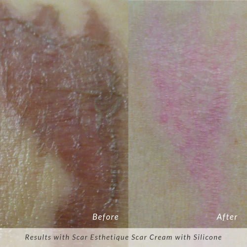 Rejûvaskin Scar Esthetique Scar Cream - Your Skincare Source