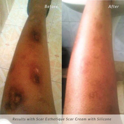 Rejûvaskin Scar Esthetique Scar Cream - Your Skincare Source