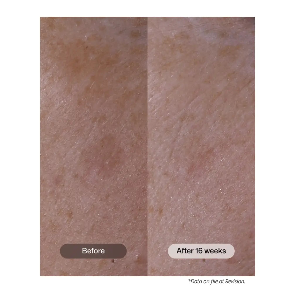 Before-and-after use of Revision Skincare Advanced Pigment Corrector+ skin comparison showing a 16-week improvement in skin texture and tone, with 'Before' on the left and 'After 16 weeks' on the right.