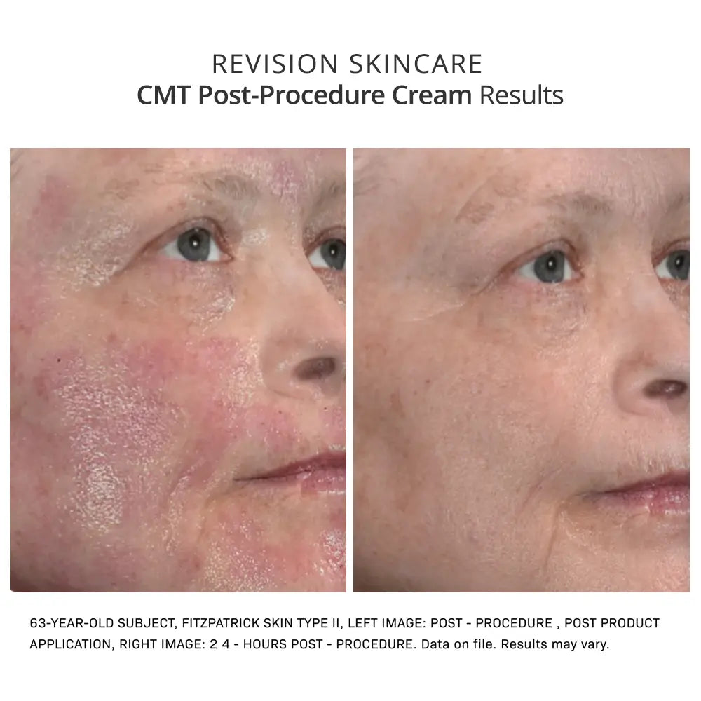 Revision Skincare CMT Post-Procedure Cream results post treatment