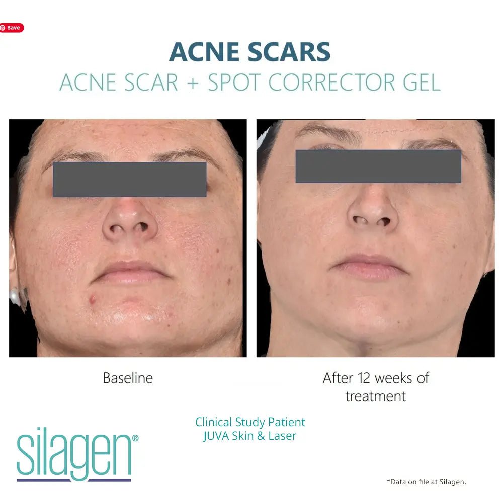 Amazing Results Silagen Acne Scar and Spot Corrector - Your Skincare Source