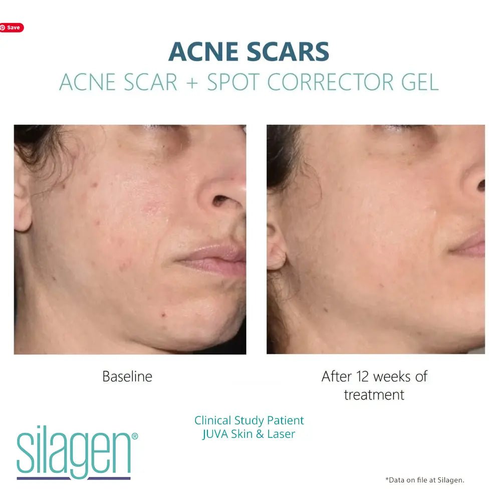 Amazing Results Silagen Acne Scar and Spot Corrector - Your Skincare Source