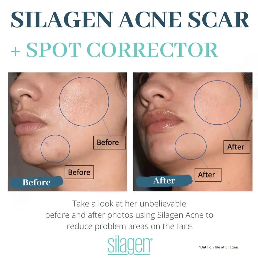 Amazing Results Silagen Acne Scar and Spot Corrector - Your Skincare Source