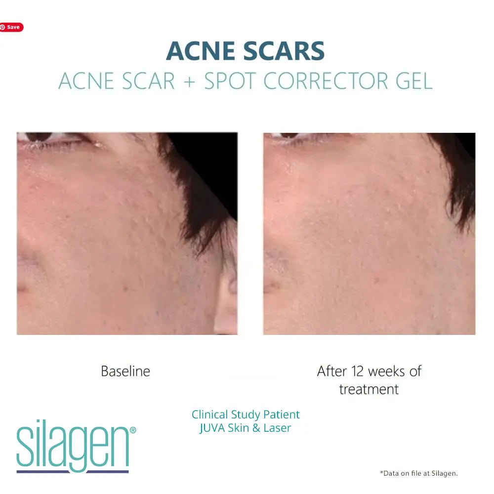 Amazing Results Silagen Acne Scar and Spot Corrector - Your Skincare Source