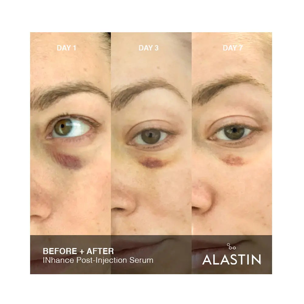 Alastin INhance Post-Injection Serum with TriHex Technology