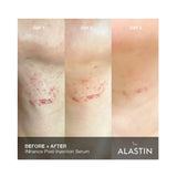 Alastin INhance Post-Injection Serum with TriHex Technology