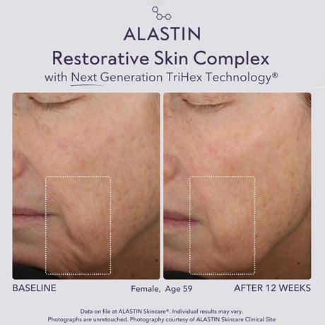 Before and after comparison of ALASTIN Restorative Skin Complex on a woman's face with visible wrinkles.