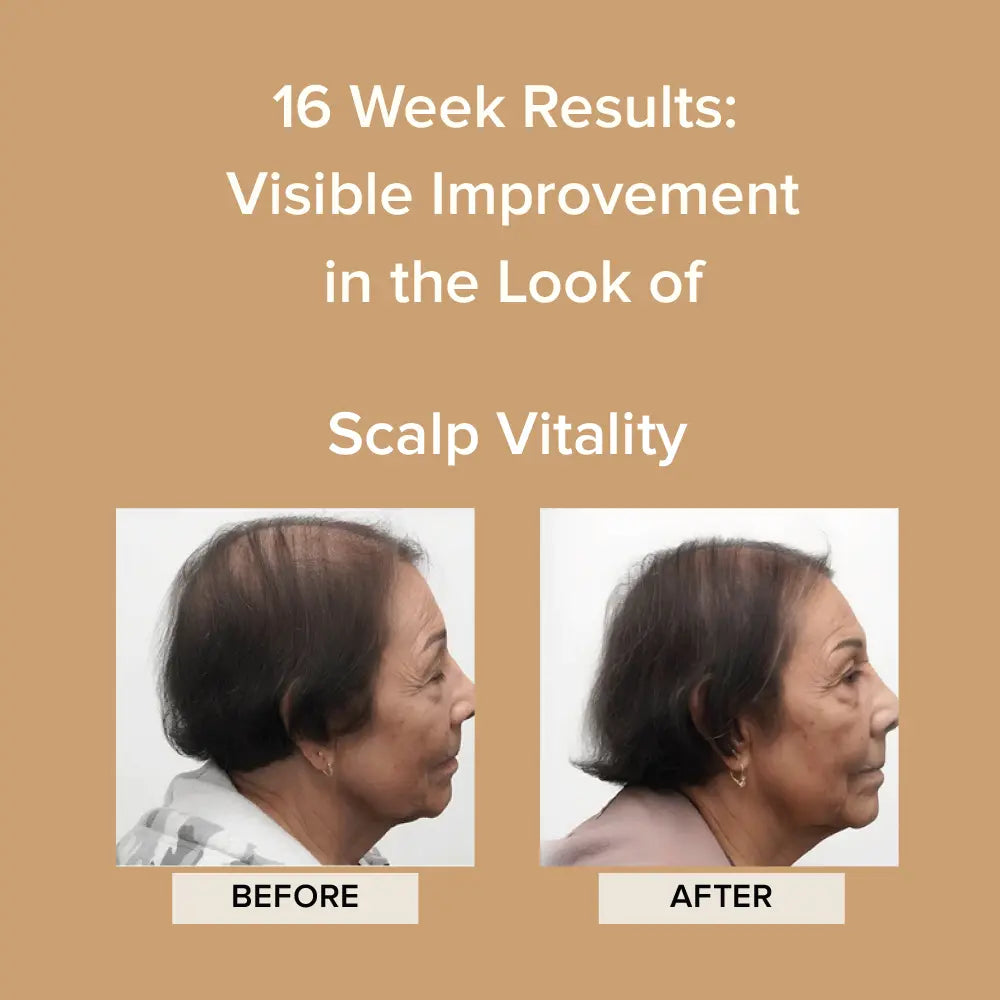 Before and after 16 weeks of Elevai Renew Exosome Scalp Serum showing improved scalp vitality on thinning hair