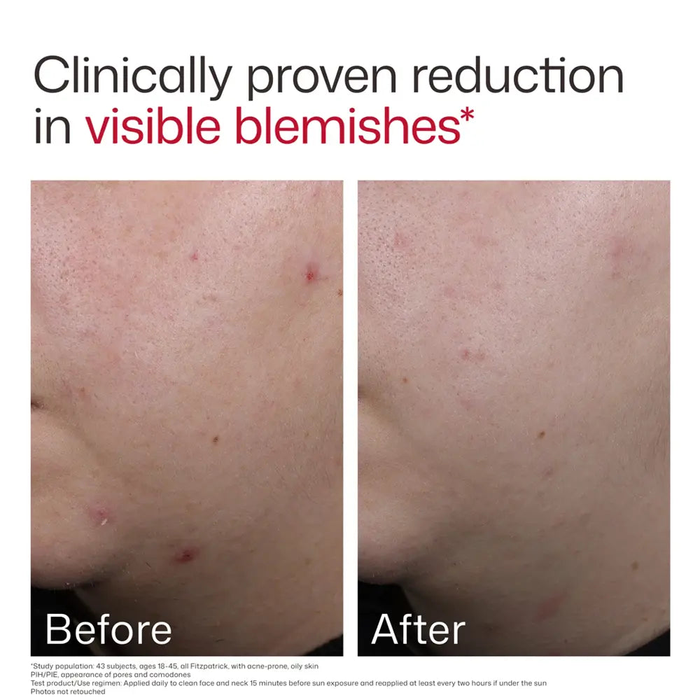 Before and after comparison after using EltaMD UV Clear Blemish-Prone and Oil Balancing SPF 50 showing a reduction in visible blemishes on skin, with the headline 'Clinically proven reduction in visible blemishes' at the top.