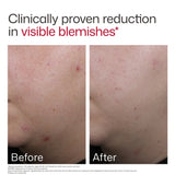 Before and after comparison after using EltaMD UV Clear Blemish-Prone and Oil Balancing SPF 50 showing a reduction in visible blemishes on skin, with the headline 'Clinically proven reduction in visible blemishes' at the top.