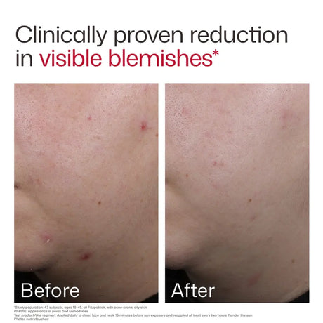 Before and after comparison after using EltaMD UV Clear Blemish-Prone and Oil Balancing SPF 50 showing a reduction in visible blemishes on skin, with the headline 'Clinically proven reduction in visible blemishes' at the top.