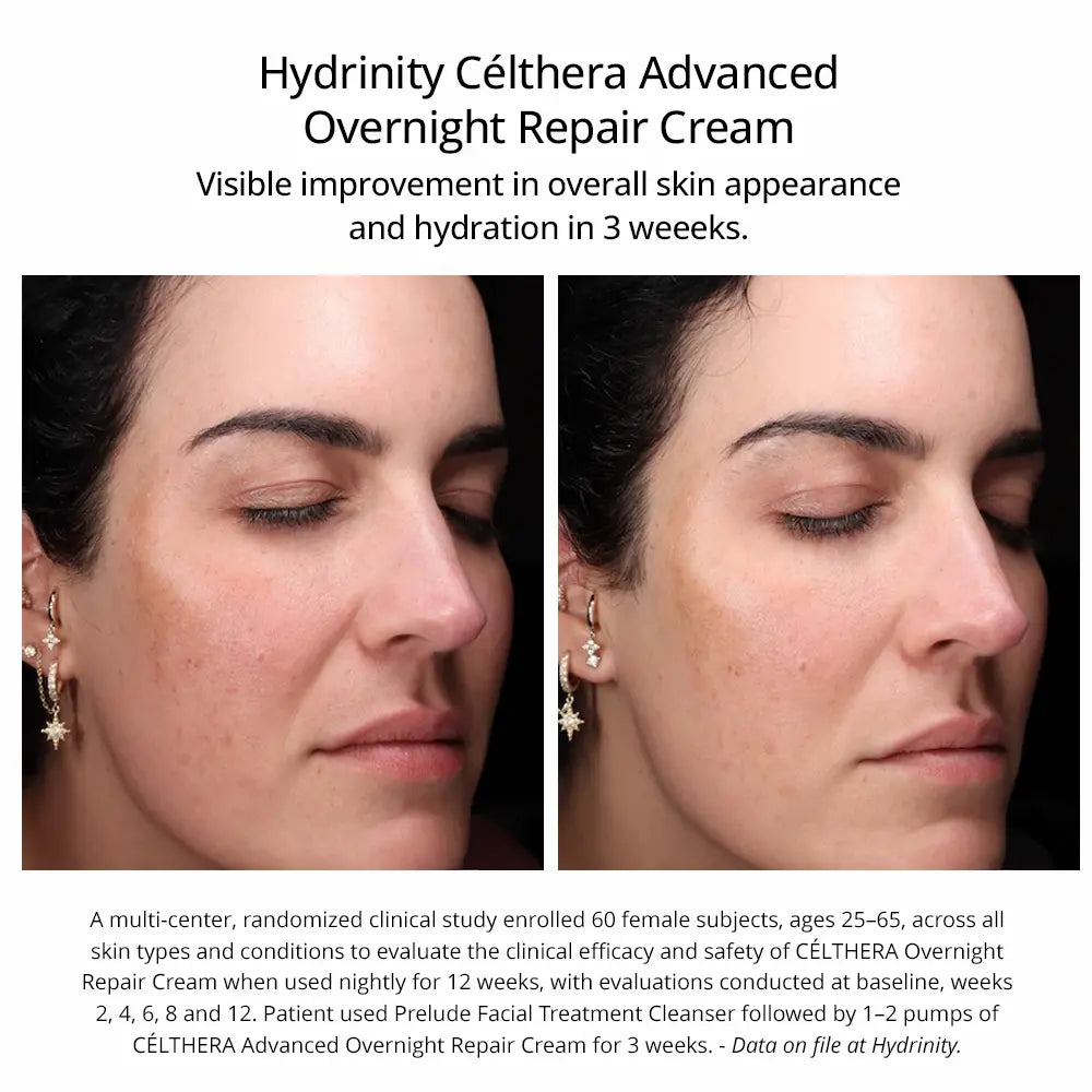 Before after results using Hydrinity Celthera