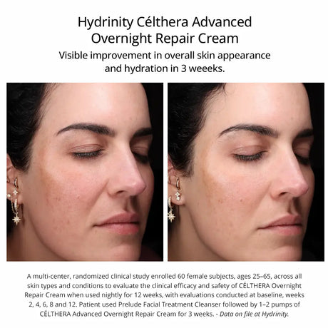 Before after results using Hydrinity Celthera
