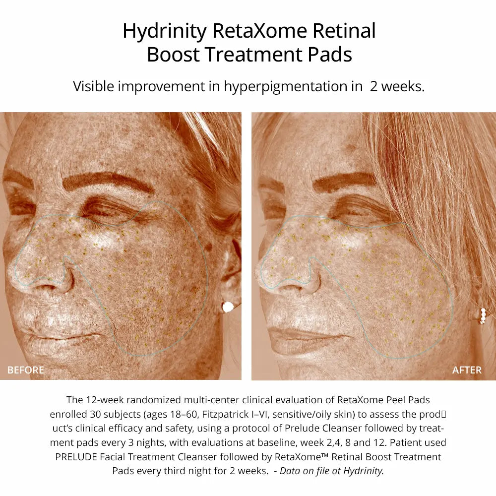 Before-and-after skin treatment results graphic for Hydrinity RetaXome Retinal Boost Treatment Pads, showing a woman's face with hyperpigmentation improvement over 12 weeks, with text detailing the clinical evaluation.
