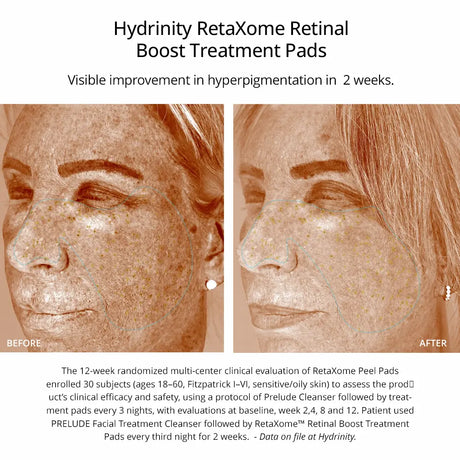 Before-and-after skin treatment results graphic for Hydrinity RetaXome Retinal Boost Treatment Pads, showing a woman's face with hyperpigmentation improvement over 12 weeks, with text detailing the clinical evaluation.