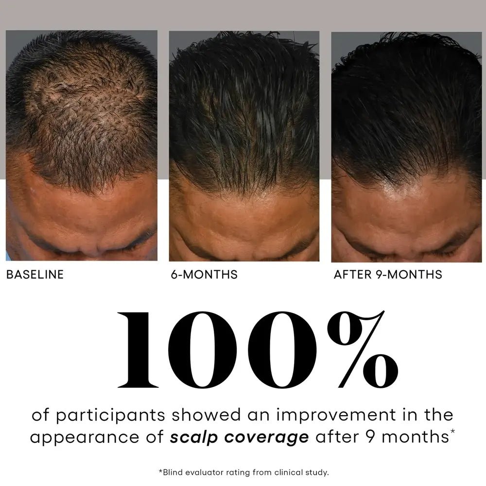Before and after comparison of scalp coverage improvement over 9 months with a 100% success rate.