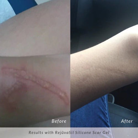 Rejûvaskin RejûvaSil Silicone Scar Gel - Your Skincare Source