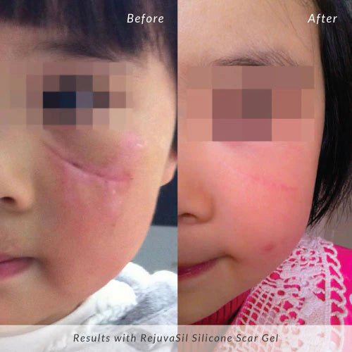 Rejûvaskin RejûvaSil Silicone Scar Gel - Your Skincare Source