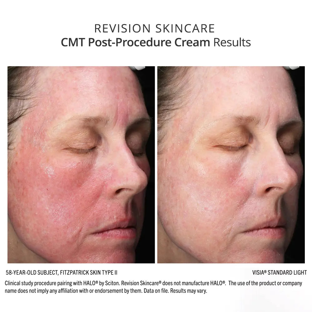 Revision Skincare CMT Post-Procedure Cream before and after results show less redness