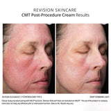 Revision Skincare CMT Post-Procedure Cream before and after results show less redness