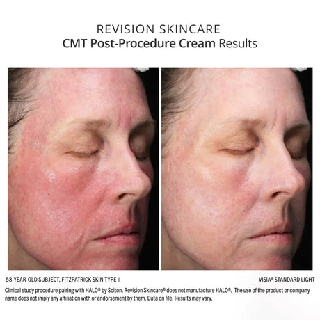 Revision Skincare CMT Post-Procedure Cream before and after results show less redness