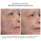 Revision Skincare CMT Post-Procedure Cream results post treatment