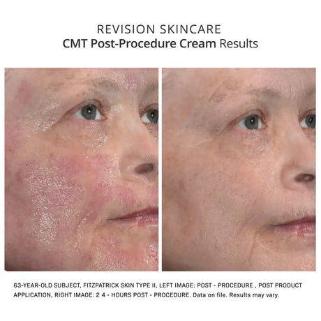 Revision Skincare CMT Post-Procedure Cream results post treatment