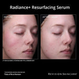 Before and after effects of Radiance+ Resurfacing Serum on a woman's face by Revision Skincare.