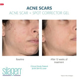 Amazing Results Silagen Acne Scar and Spot Corrector - Your Skincare Source