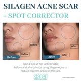 Amazing Results Silagen Acne Scar and Spot Corrector - Your Skincare Source