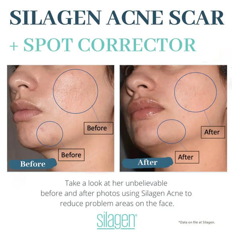 Amazing Results Silagen Acne Scar and Spot Corrector - Your Skincare Source