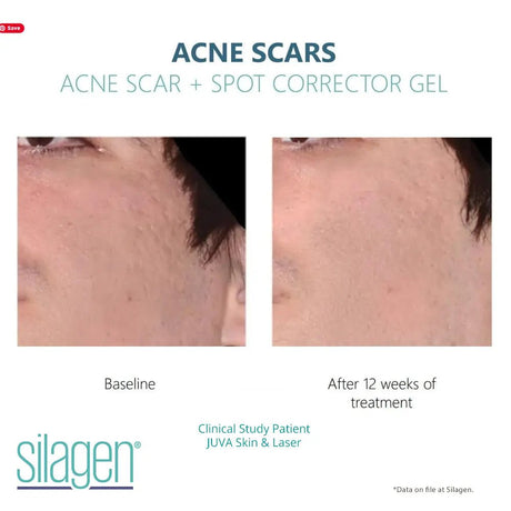 Amazing Results Silagen Acne Scar and Spot Corrector - Your Skincare Source