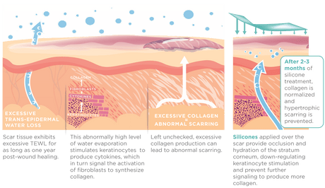Silagen® 100% Pure Silicone Gel + SPF 30 30g - Your Skincare Source