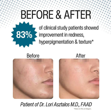 Before and after skin treatment comparison with 83% improvement rate with Silagen Reveal 