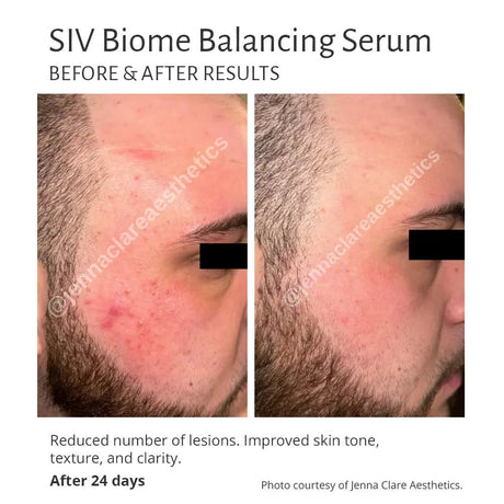 Before and after results of SIV Biome Balancing Serum on a person's face.
