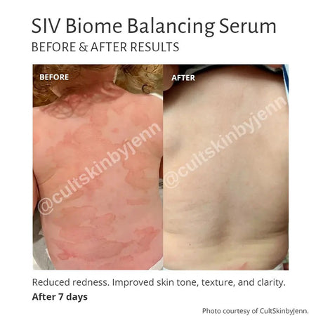 Before and after results of SIV Biome Balancing Serum on skin with reduced redness and improved skin tone.