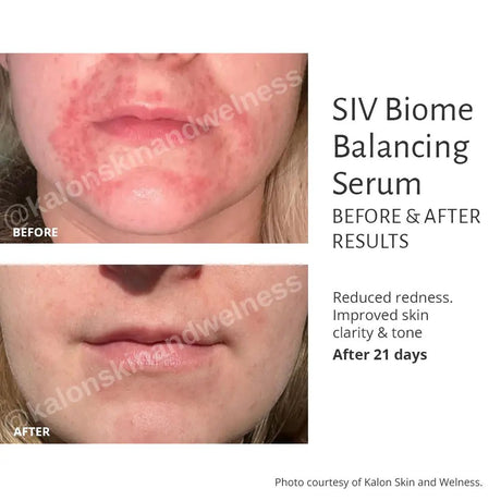 Before and after results of SIV Biome Balancing Serum on a person's face, showing reduced redness and improved skin clarity.