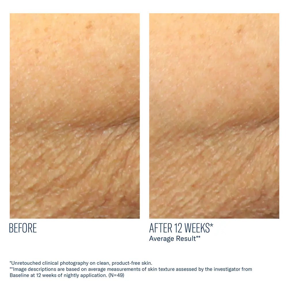 AlphaRet Body before and after comparison of skin texture improvement after 12 weeks, showing a clear improvement.