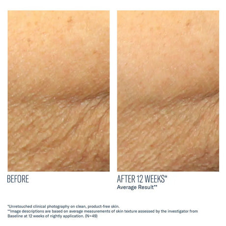 AlphaRet Body before and after comparison of skin texture improvement after 12 weeks, showing a clear improvement.