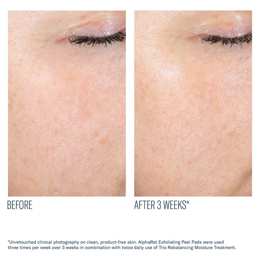 AlphaRet Exfoliating Pads Before and after comparison of skin texture with text indicating a 3-week treatment effect.